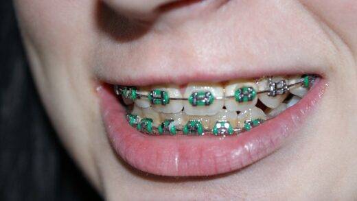 Girls with Braces Captions for Instagram